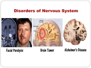 Disorders of Nervous System
 