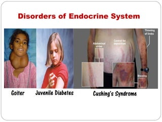 Disorders of Endocrine System
 