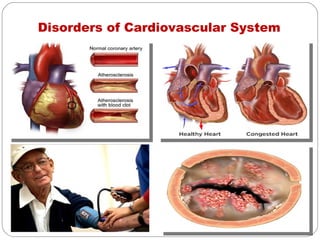 Disorders of Cardiovascular System
 