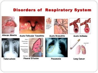 Disorders of Respiratory System
 
