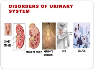 DISORDERS OF URINARY
SYSTEM
 