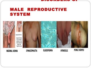 DISORDERS OF

MALE REPRODUCTIVE
SYSTEM
 
