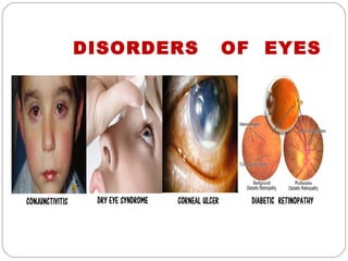 DISORDERS   OF EYES
 