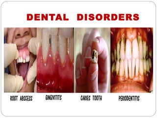 DENTAL DISORDERS
 