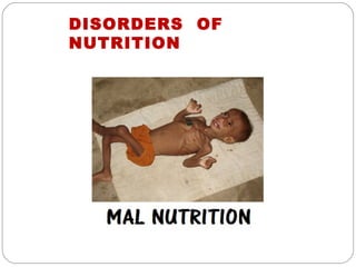 DISORDERS OF
NUTRITION
 