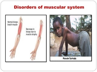 Disorders of muscular system
 