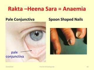 Rakta –Heena Sara = Anaemia
Pale Conjunctiva Spoon Shaped Nails
10/10/2018 Prof.Dr.R.R.Deshpande 64
 