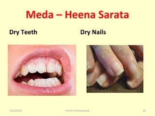 Meda – Heena Sarata
Dry Teeth Dry Nails
10/10/2018 Prof.Dr.R.R.Deshpande 83
 