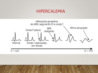 HIPERCALEMIA
 