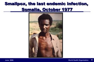 Smallpox, the last endemic infection,  Somalia, October 1977 