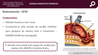 DOENÇA HEMOLÍTICA PERINATAL
portaldeboaspraticas.iff.fiocruz.br
Cordocentese:
• Método invasivo e com riscos.
• Caracteriza-se pela punção do cordão umbilical
para pesquisa da anemia fetal e tratamento -
PADRÃO OURO de investigação.
Fonte figura: Biomedicina UNA 2016 | Embriologia: Cordocentese
http://embriologiabiomed.blogspot.com/2016/06/cordocentese.html
Rastreamento - FETO
É retirada uma amostra do sangue de cordão para
exames Hb, ABO/Rh e Coombs Direto.
 