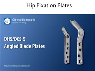 Hip Fixation Plates
 