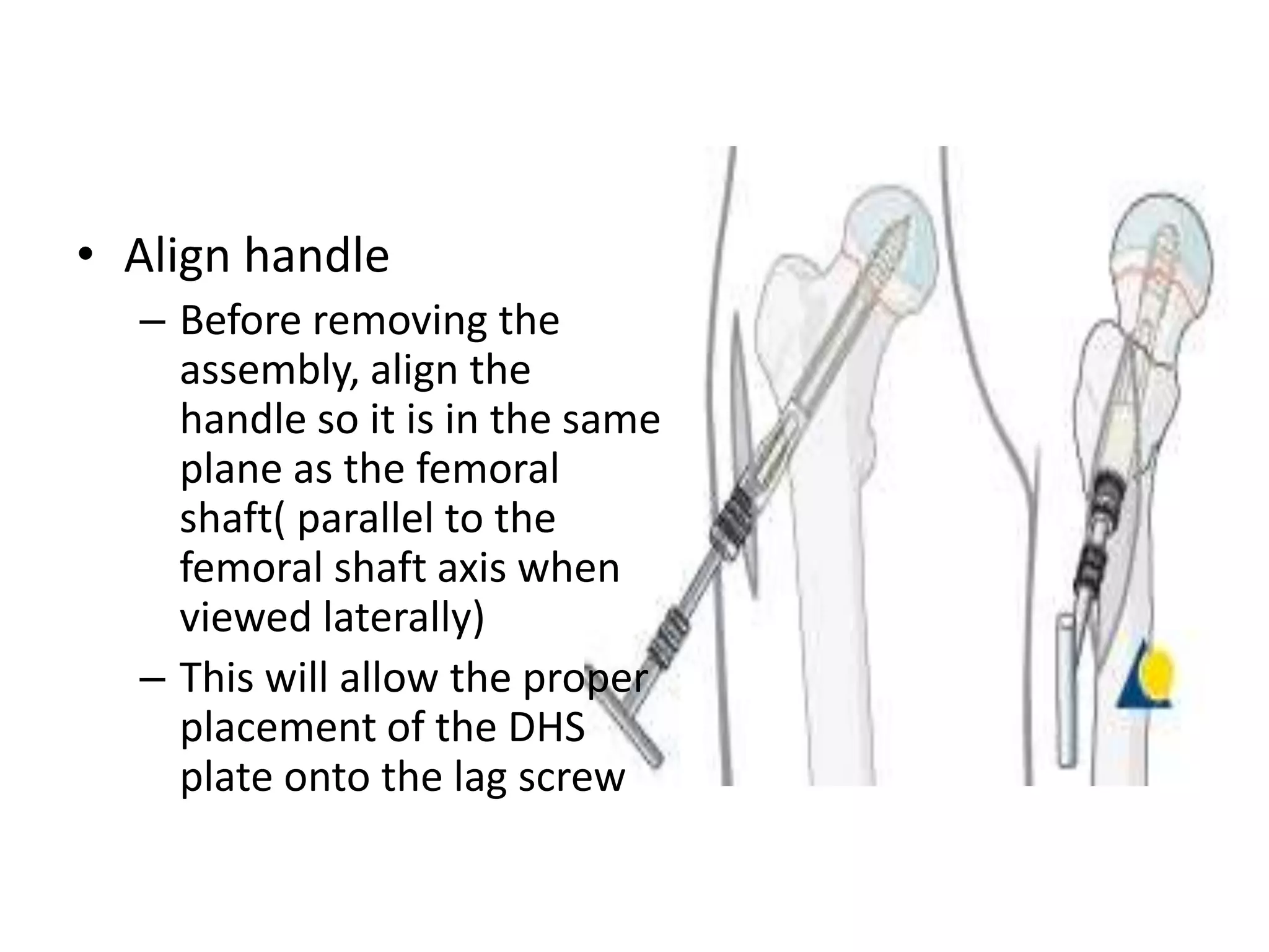 Dynamic Hip Screw PPTX
