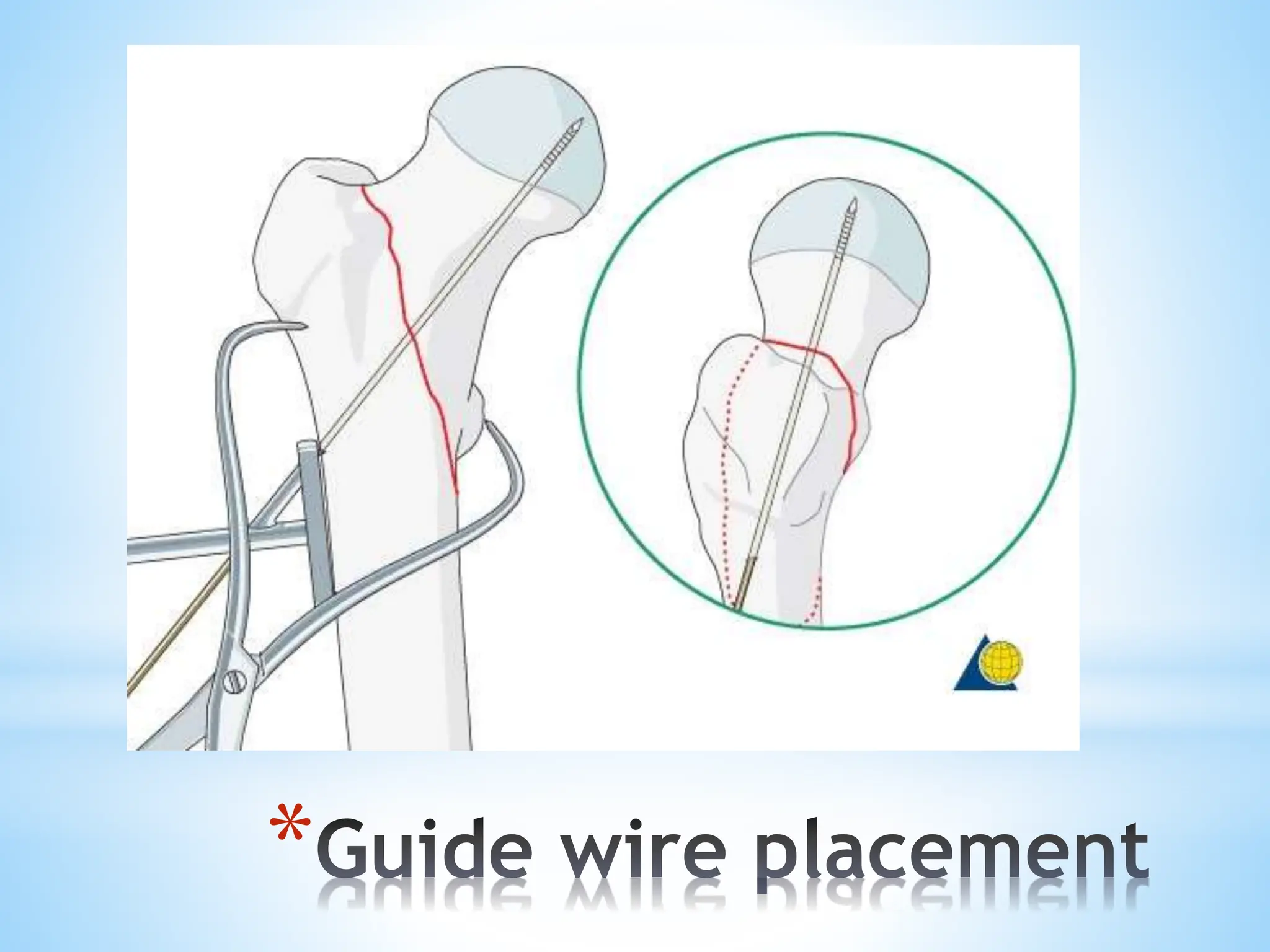 Dhs Principles DHS principles Biomechanics presentation.pdf