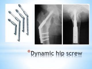 Dhs Principles DHS principles Biomechanics presentation.pdf