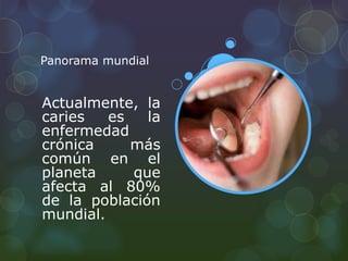 Panorama mundial 
Actualmente, la 
caries es la 
enfermedad 
crónica más 
común en el 
planeta que 
afecta al 80% 
de la población 
mundial. 
 