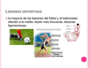 LESIONES DEPORTIVAS
 la mayoría de las lesiones del fútbol y el baloncesto
afectan a la rodilla, lesión más frecuente, le...