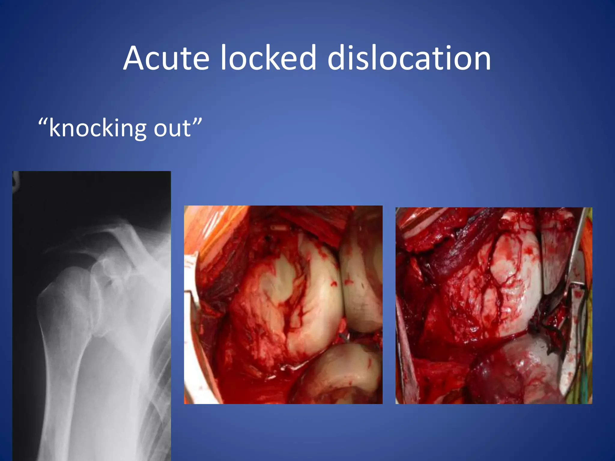Acute locked dislocation 
“knocking out” 
 
