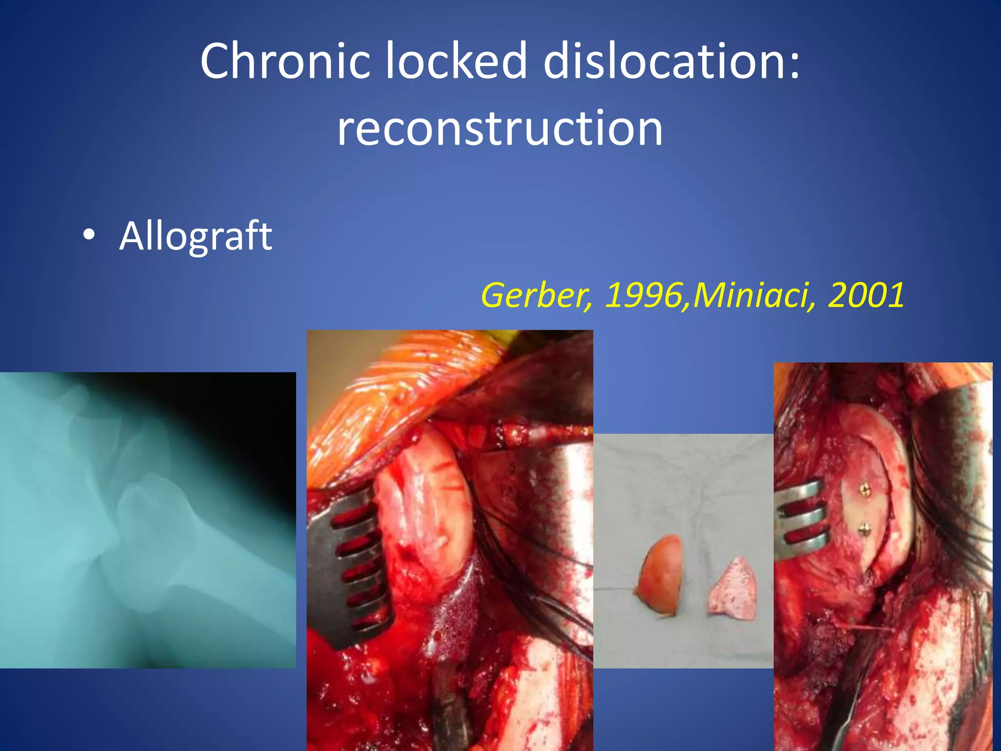 Chronic locked dislocation: 
reconstruction 
• Allograft 
Gerber, 1996,Miniaci, 2001 
 