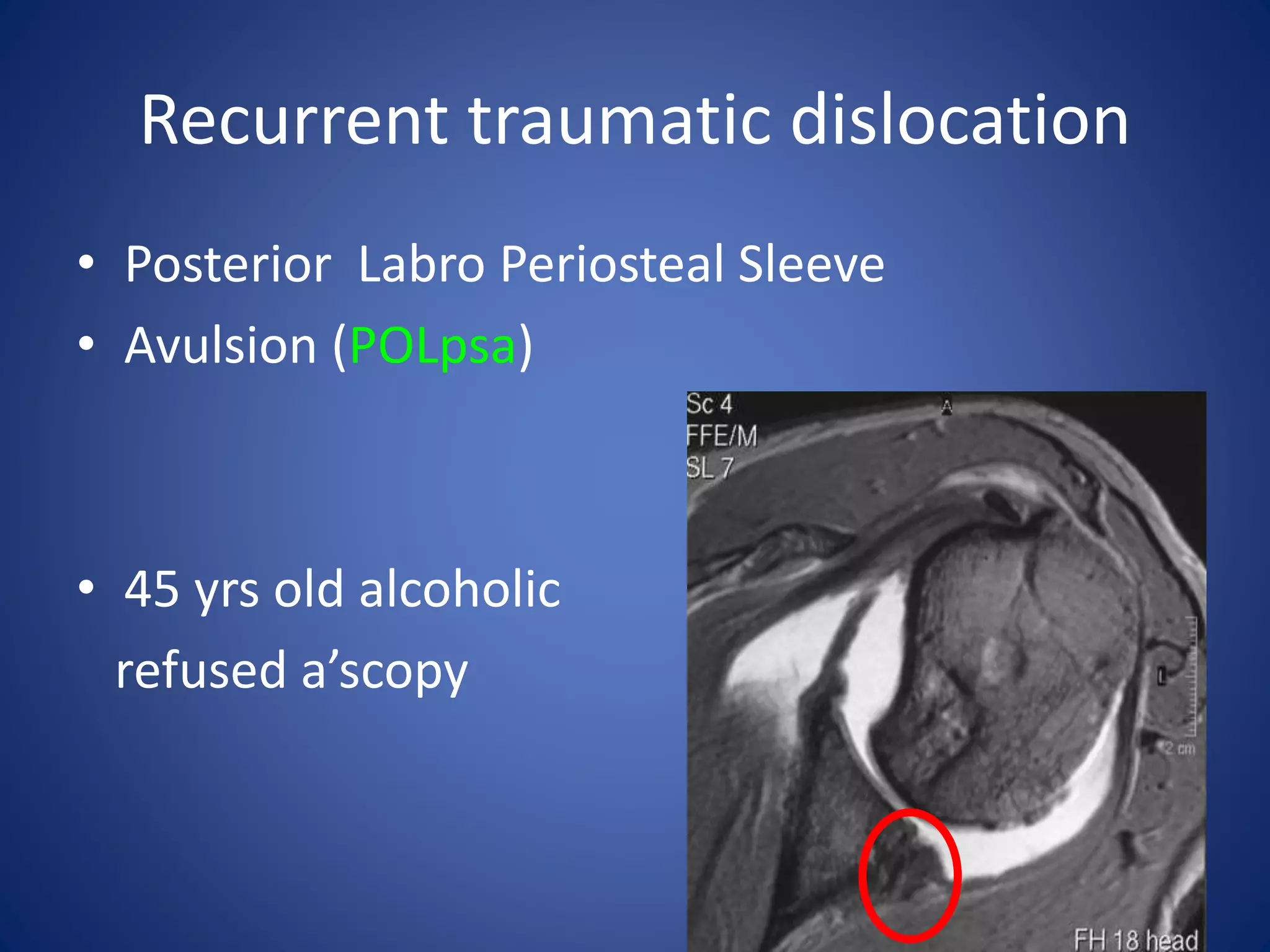 Recurrent traumatic dislocation 
• Posterior Labro Periosteal Sleeve 
• Avulsion (POLpsa) 
• 45 yrs old alcoholic 
refused a’scopy 
 