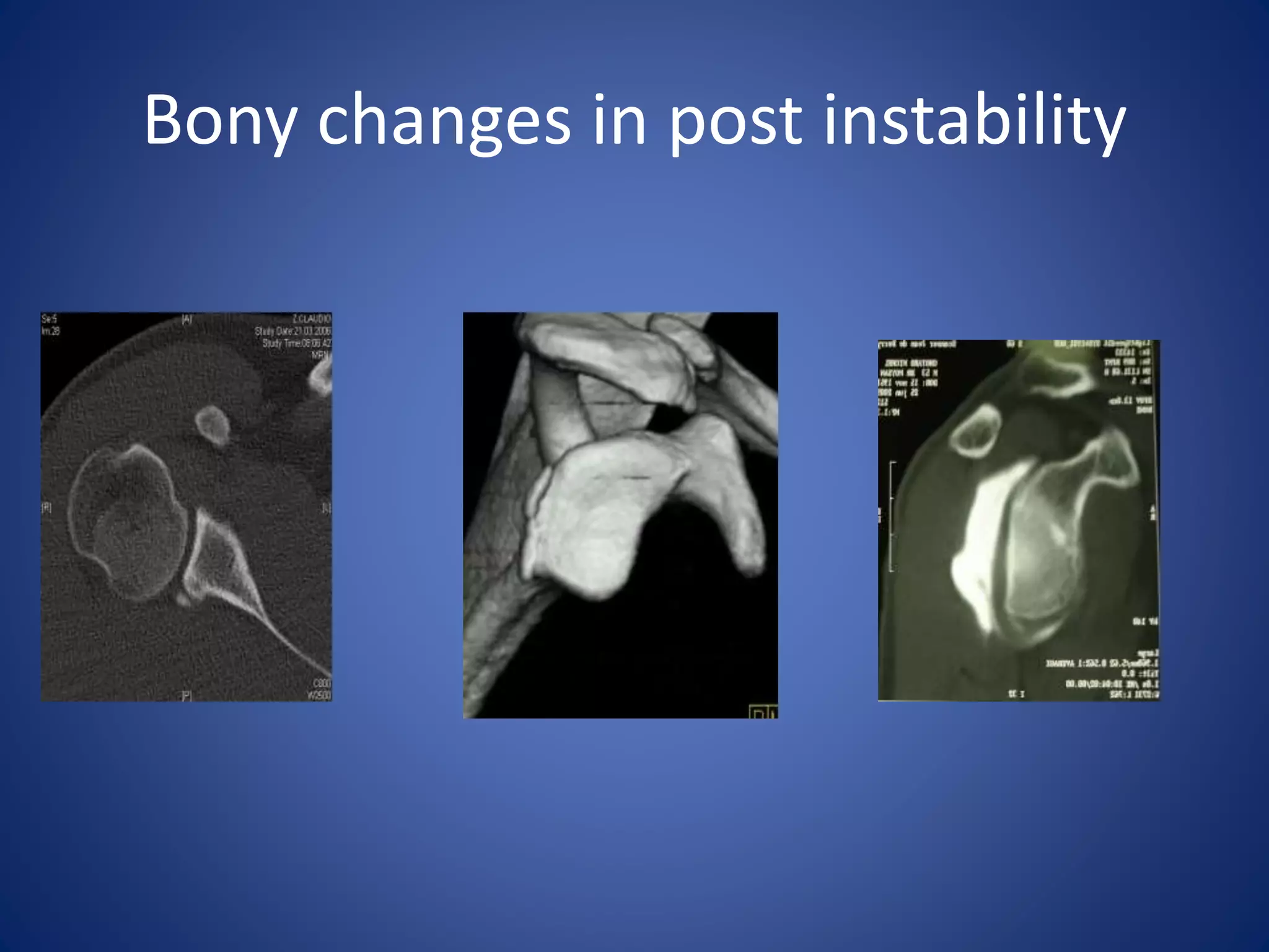 Bony changes in post instability 
 
