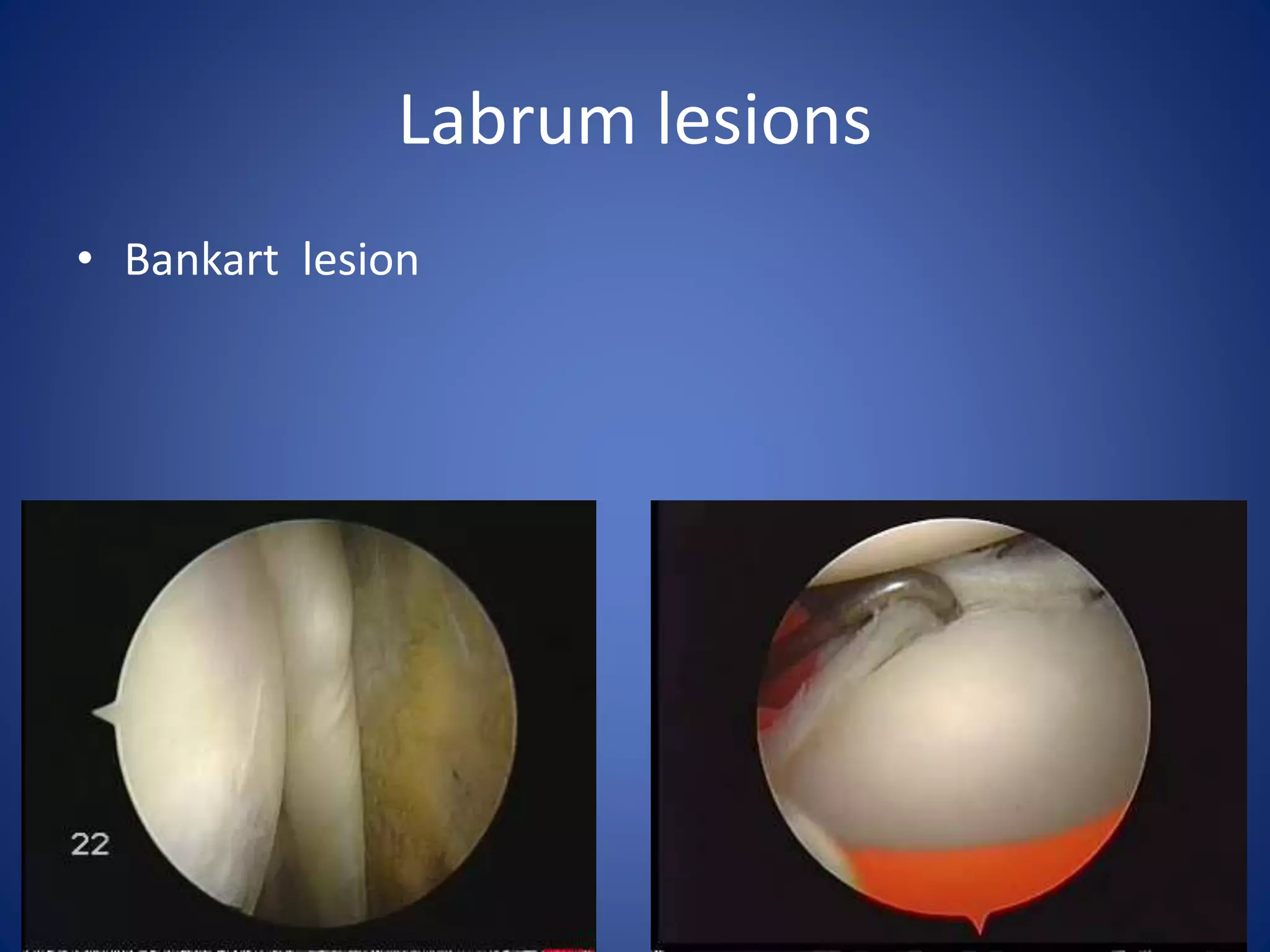 Labrum lesions 
• Bankart lesion 
 