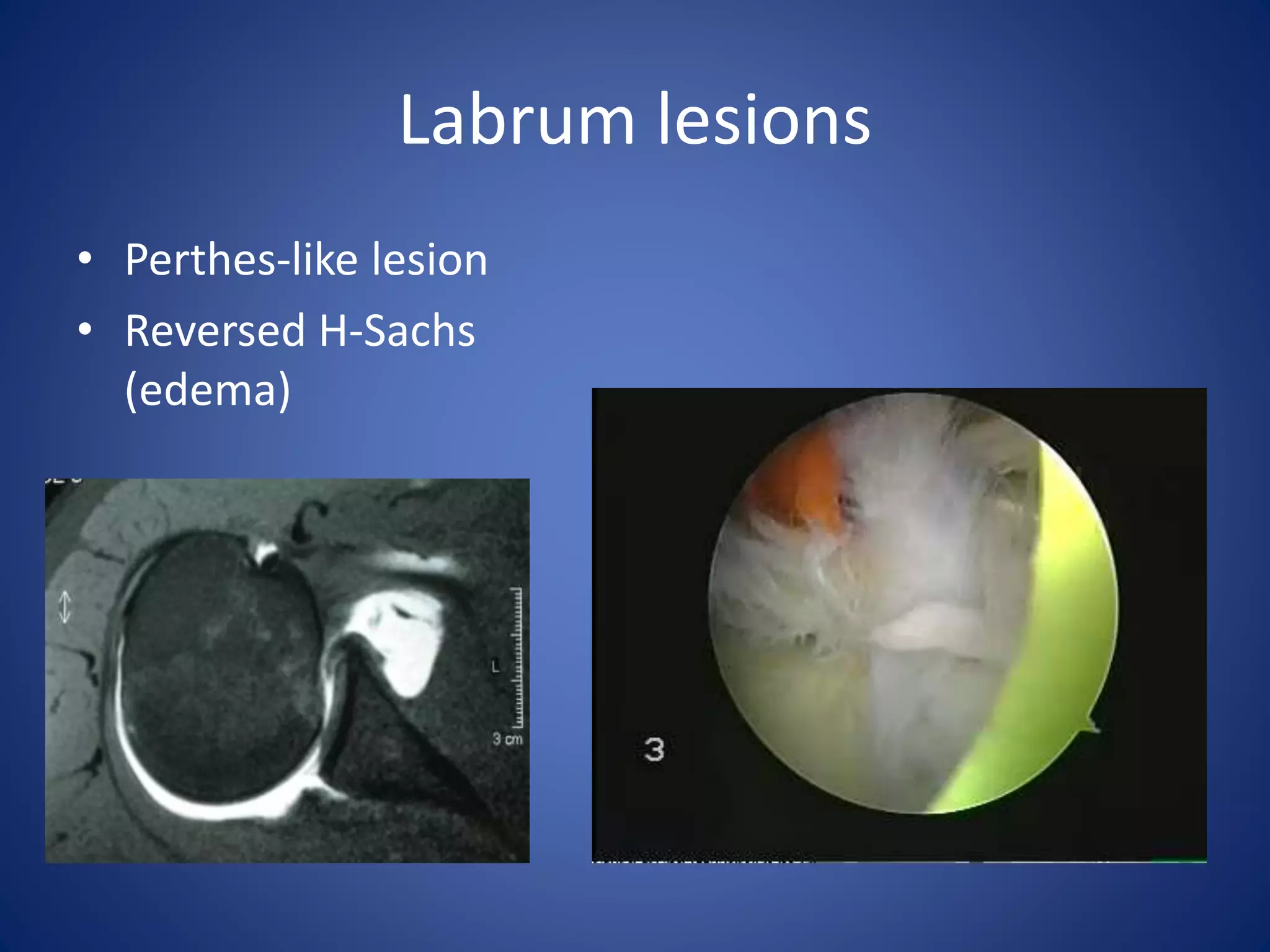Labrum lesions 
• Perthes-like lesion 
• Reversed H-Sachs 
(edema) 
 
