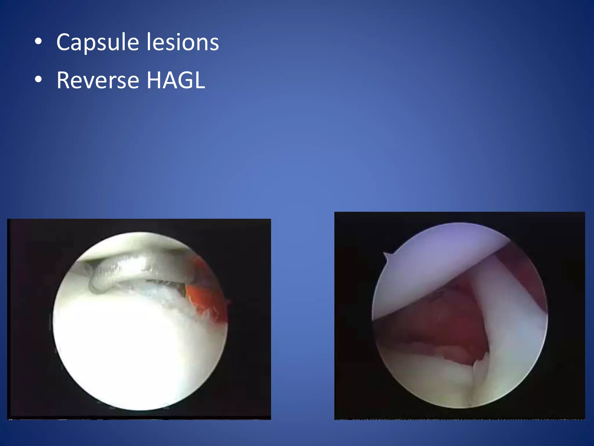 • Capsule lesions 
• Reverse HAGL 
 
