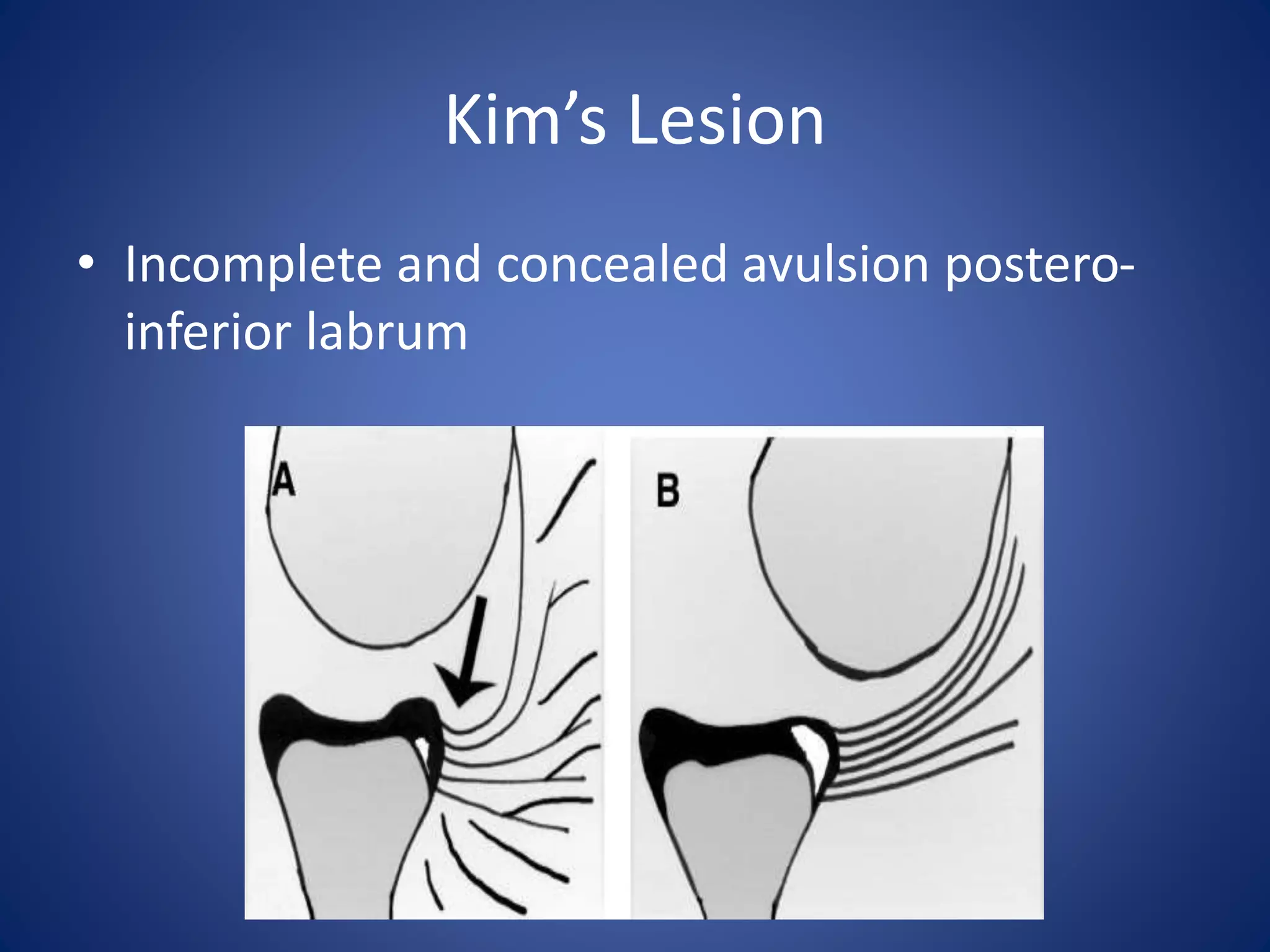 Kim’s Lesion 
• Incomplete and concealed avulsion postero-inferior 
labrum 
 