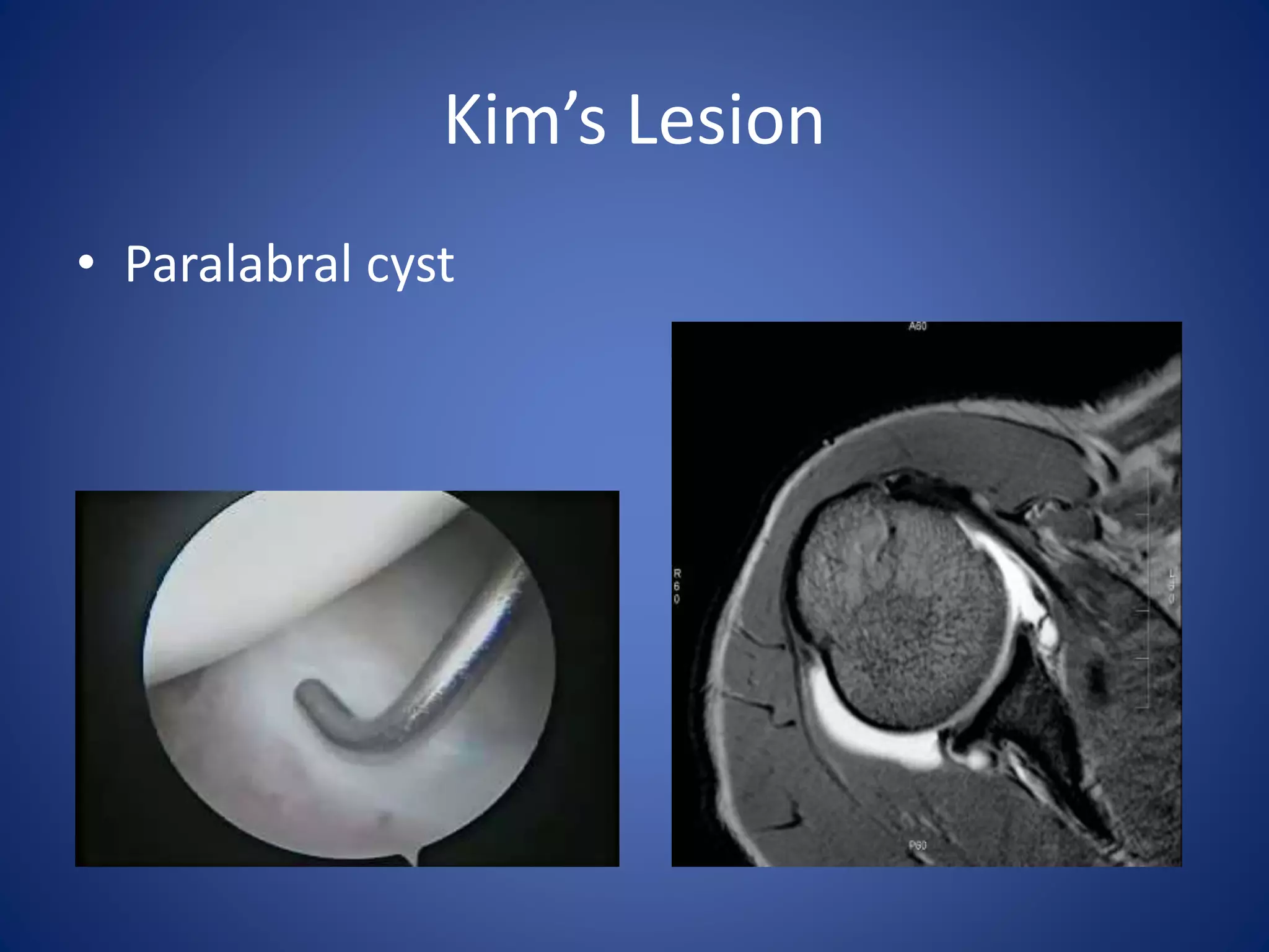 Kim’s Lesion 
• Paralabral cyst 
 