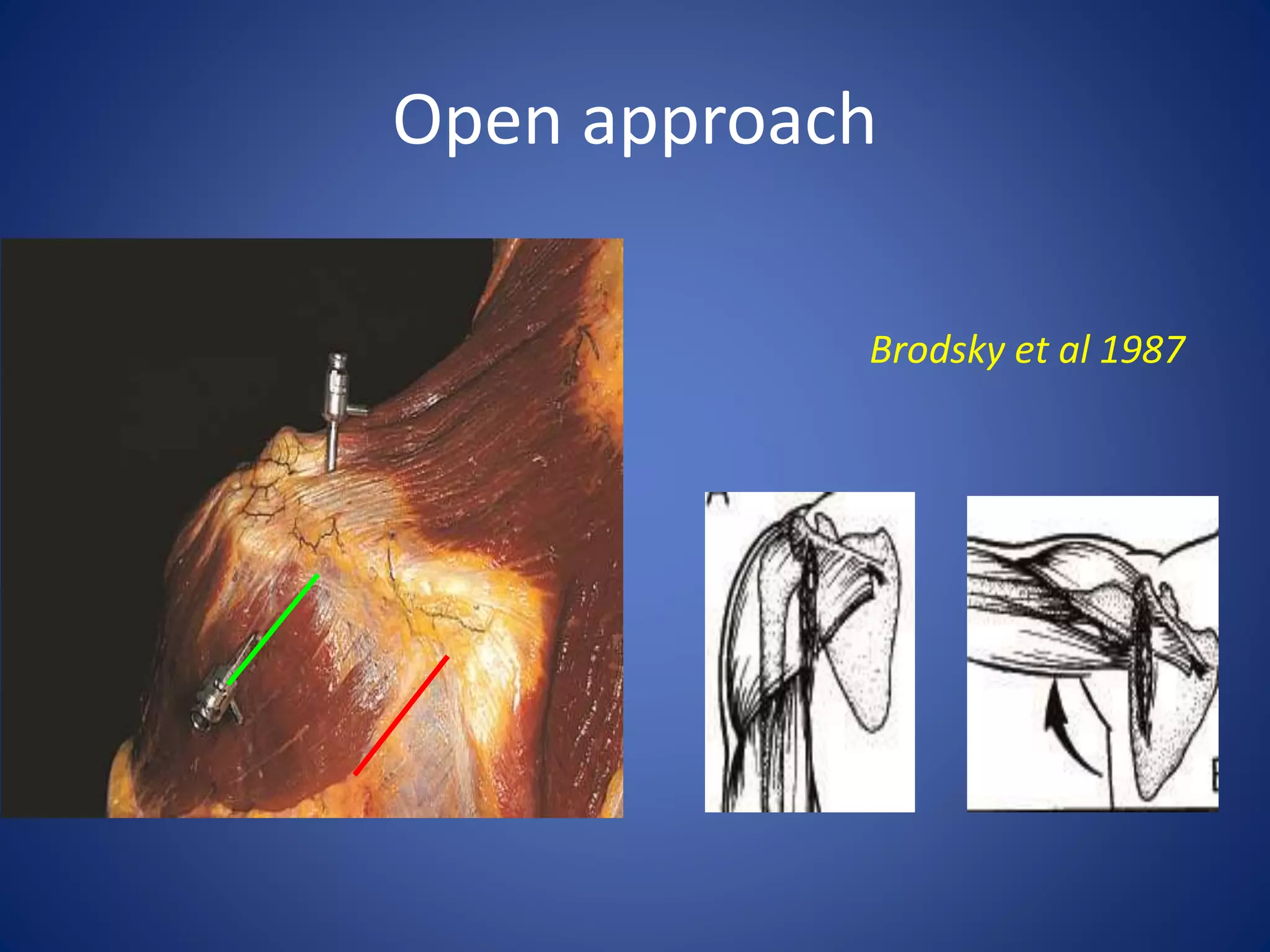 Open approach 
Brodsky et al 1987 
 