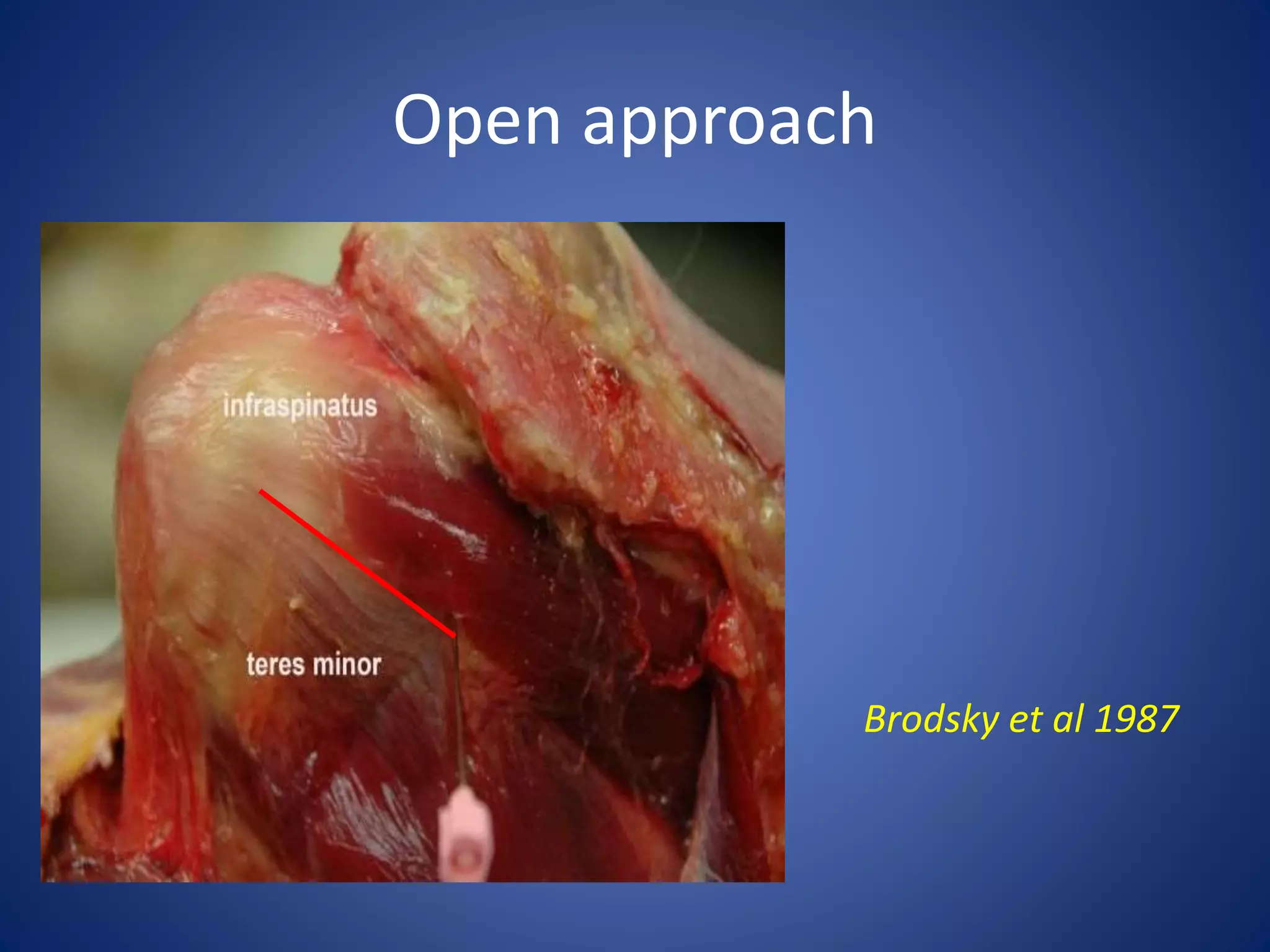 Open approach 
Brodsky et al 1987 
 