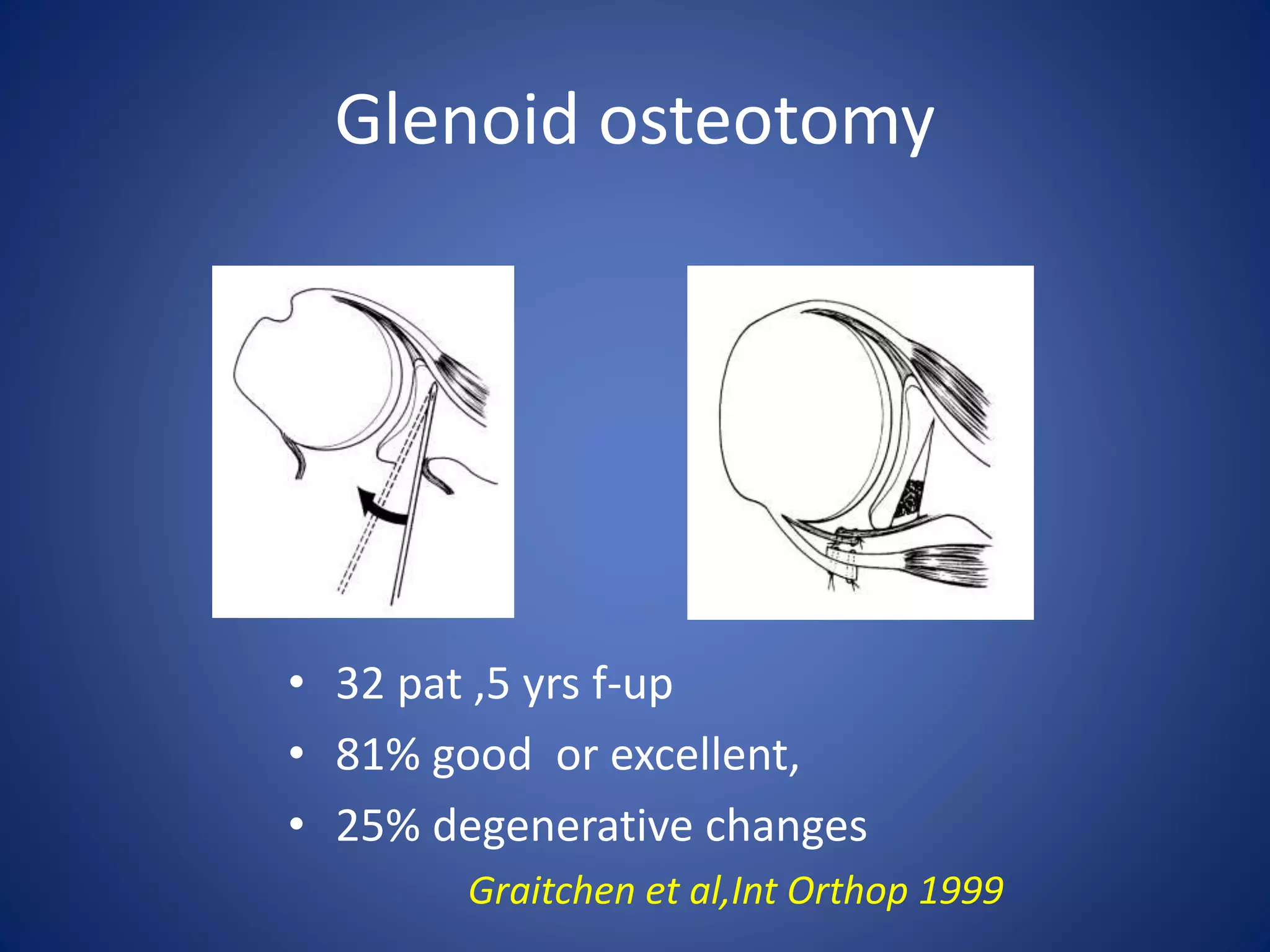 Glenoid osteotomy 
• 32 pat ,5 yrs f-up 
• 81% good or excellent, 
• 25% degenerative changes 
Graitchen et al,Int Orthop 1999 
 