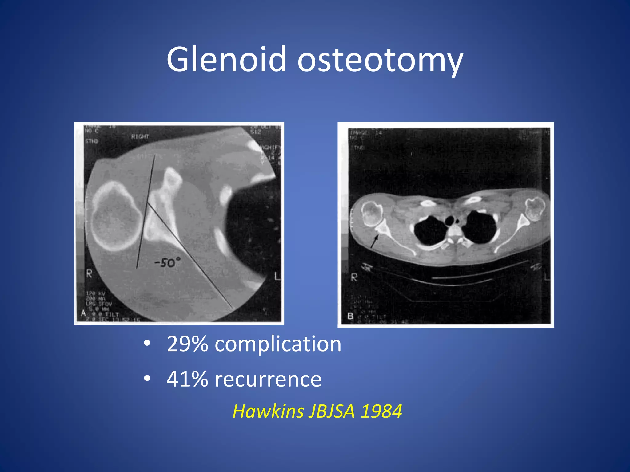 Glenoid osteotomy 
• 29% complication 
• 41% recurrence 
Hawkins JBJSA 1984 
 