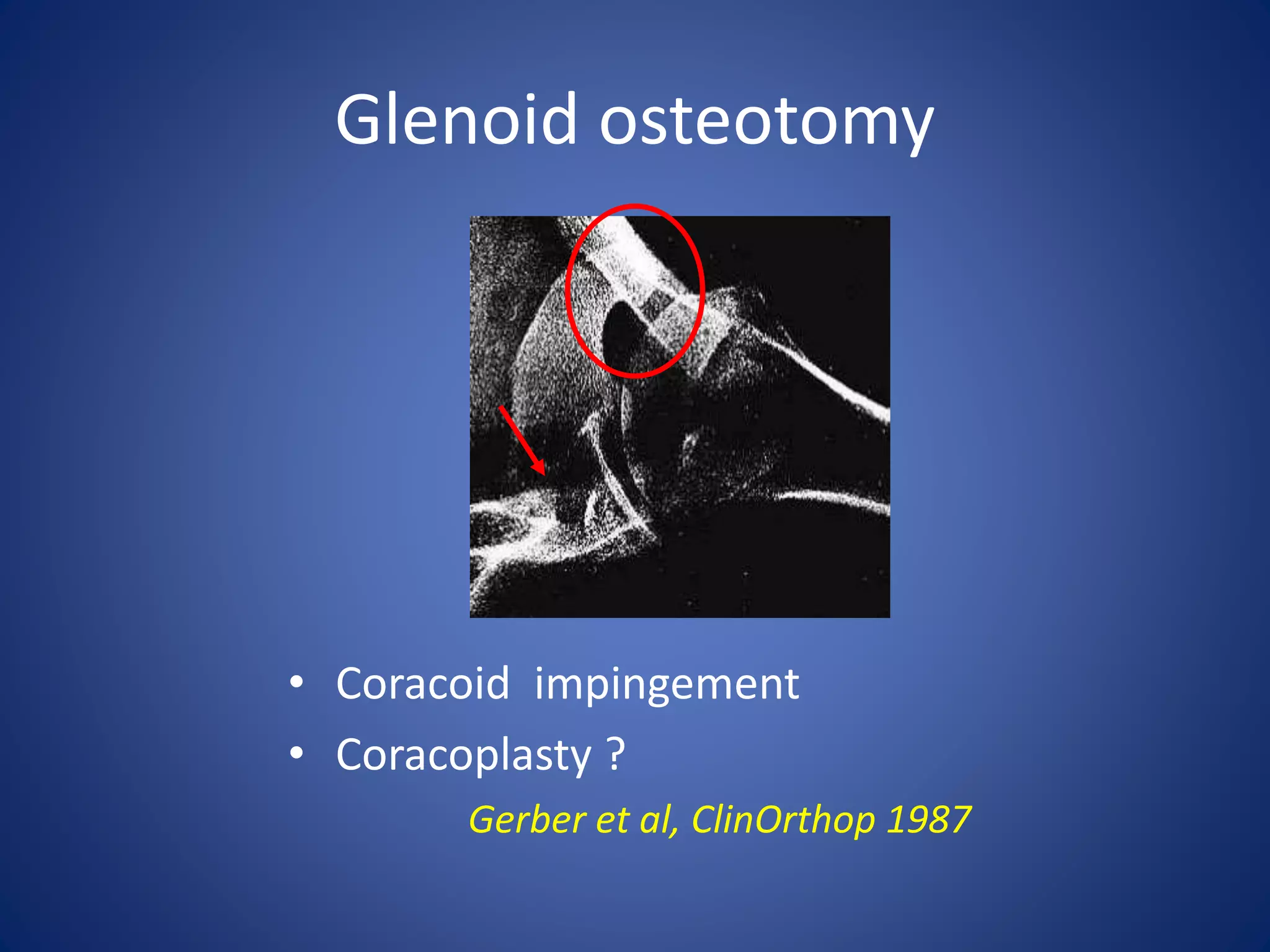 Glenoid osteotomy 
• Coracoid impingement 
• Coracoplasty ? 
Gerber et al, ClinOrthop 1987 
 