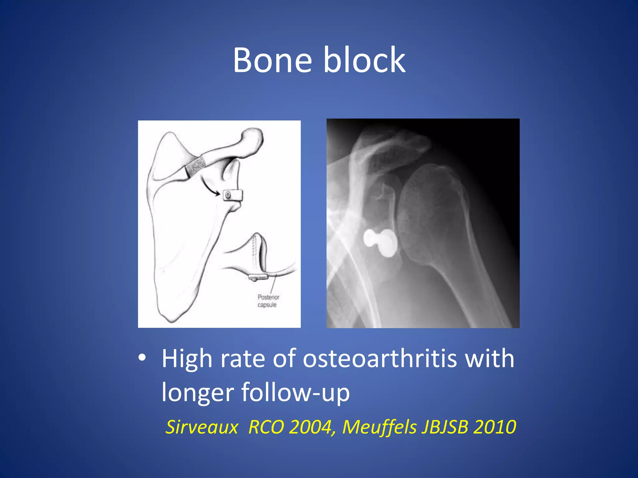 Bone block 
• High rate of osteoarthritis with 
longer follow-up 
Sirveaux RCO 2004, Meuffels JBJSB 2010 
 