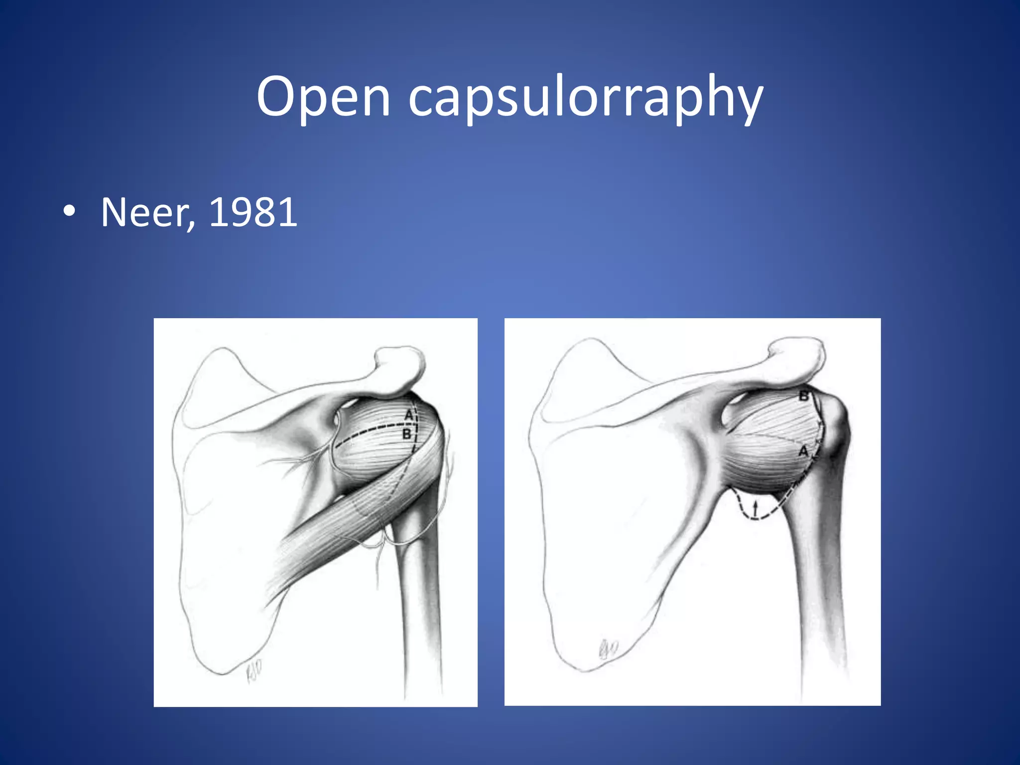 Open capsulorraphy 
• Neer, 1981 
 