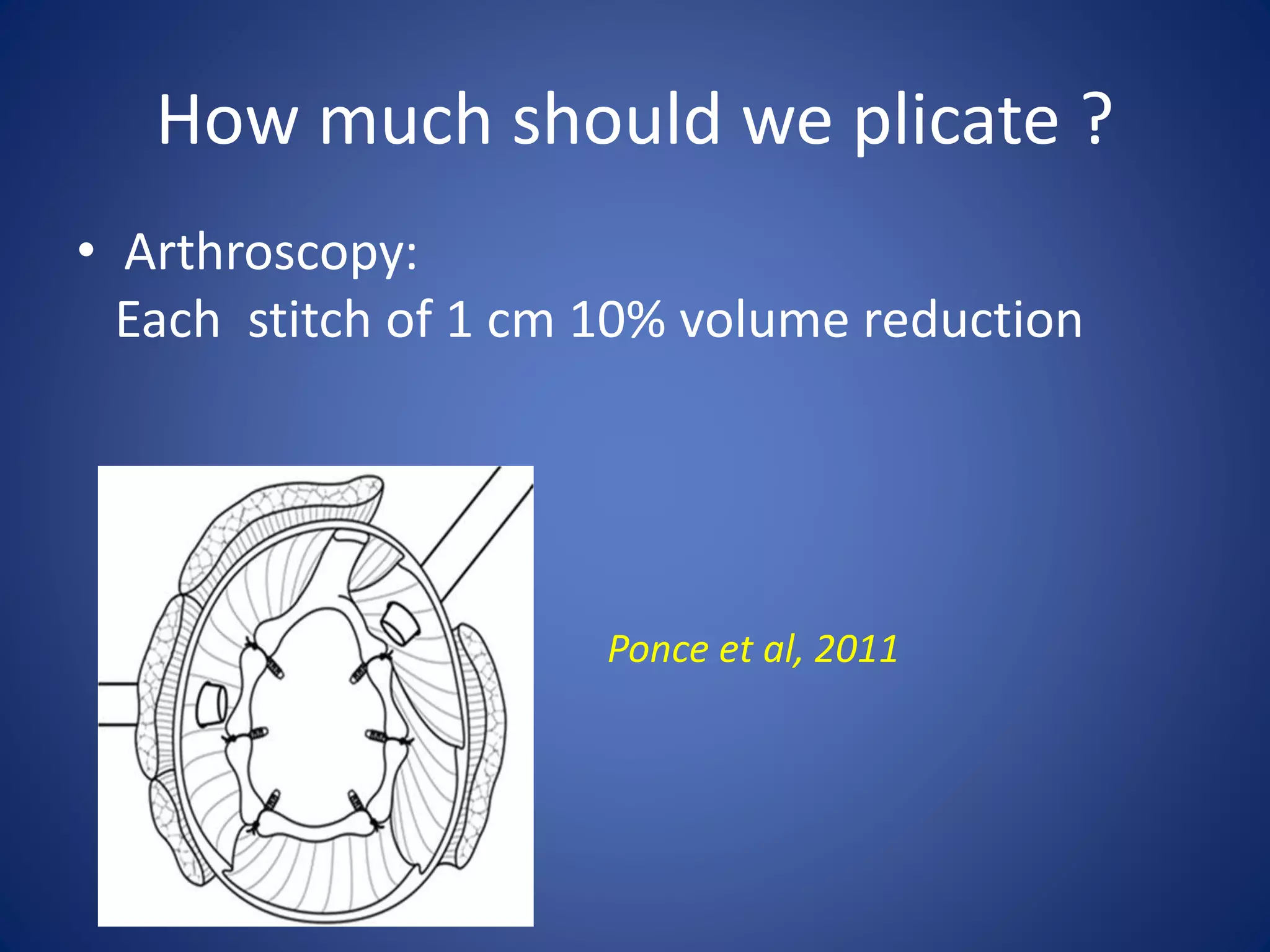 How much should we plicate ? 
• Arthroscopy: 
Each stitch of 1 cm 10% volume reduction 
Ponce et al, 2011 
 
