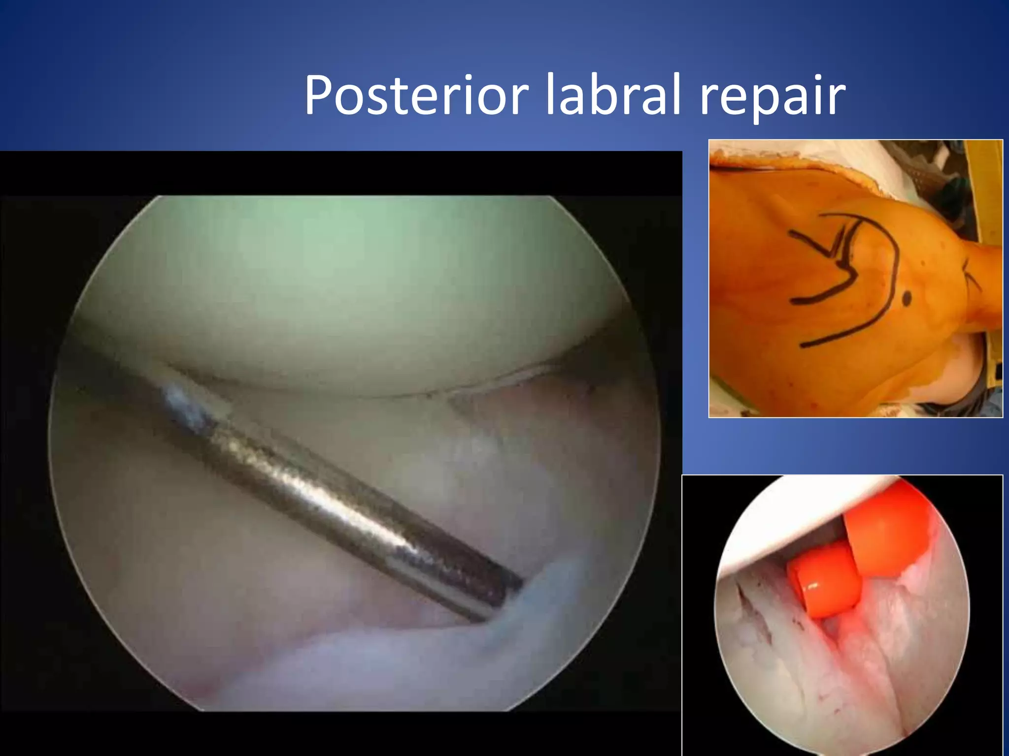 Posterior labral repair 
 