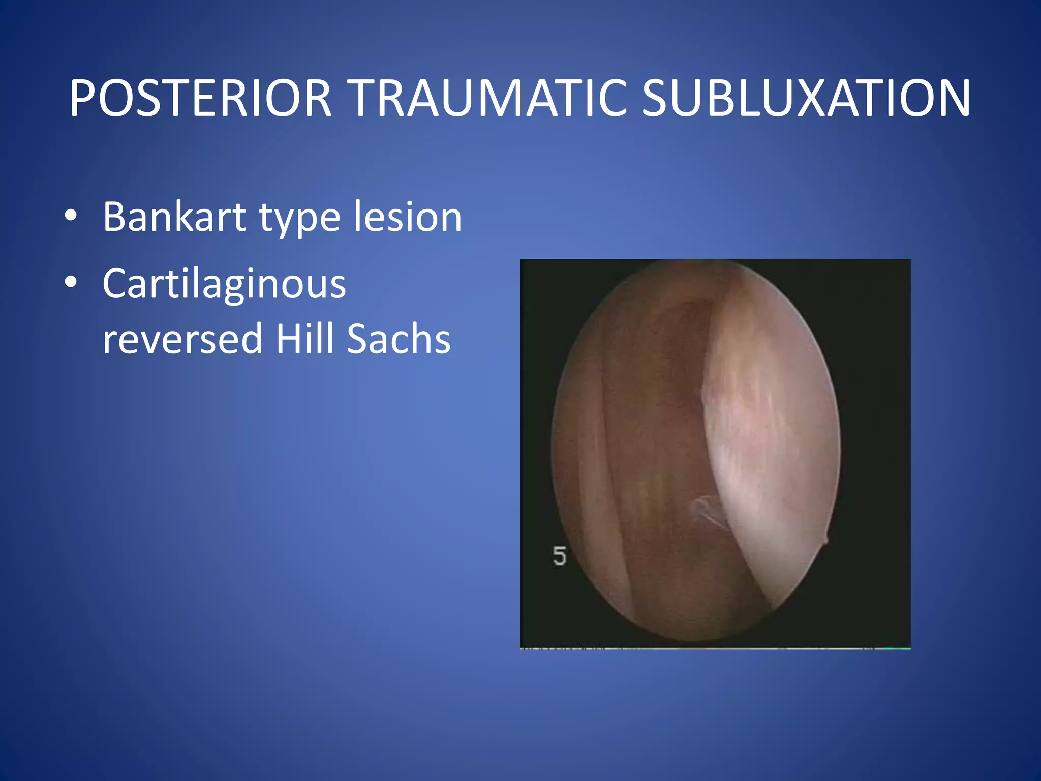 POSTERIOR TRAUMATIC SUBLUXATION 
• Bankart type lesion 
• Cartilaginous 
reversed Hill Sachs 
 
