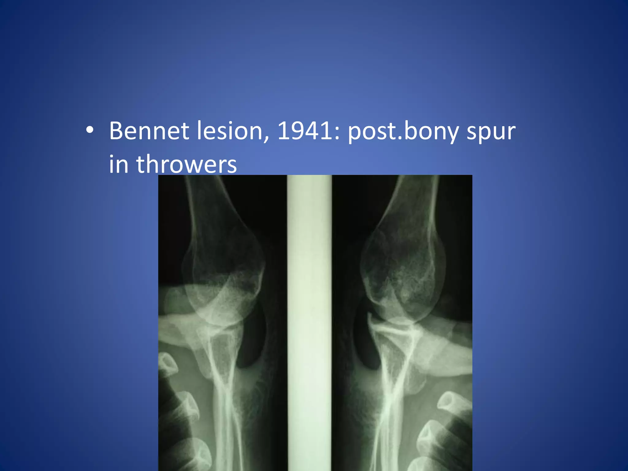 • Bennet lesion, 1941: post.bony spur 
in throwers 
 