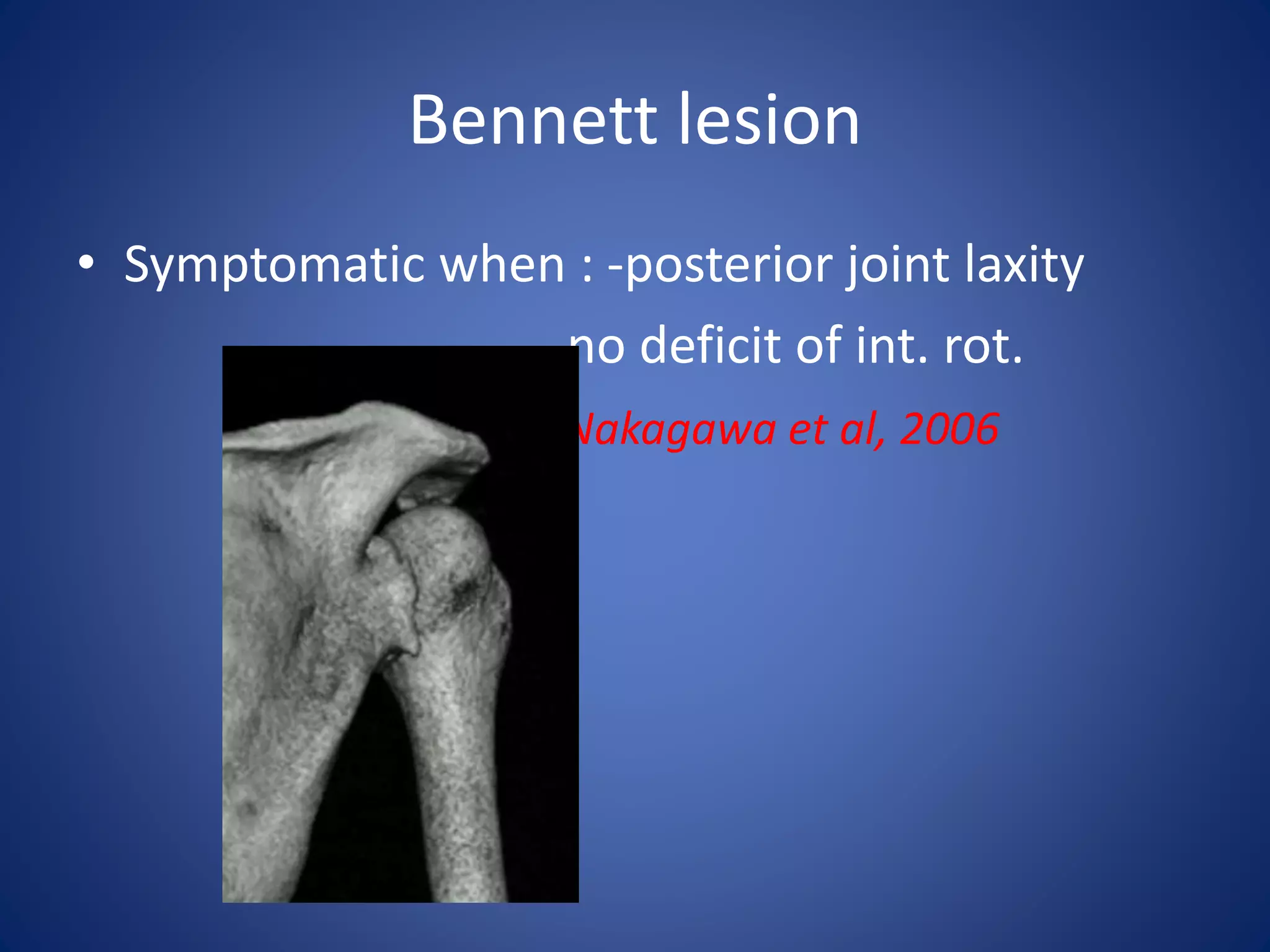 Bennett lesion 
• Symptomatic when : -posterior joint laxity 
- no deficit of int. rot. 
Nakagawa et al, 2006 
 