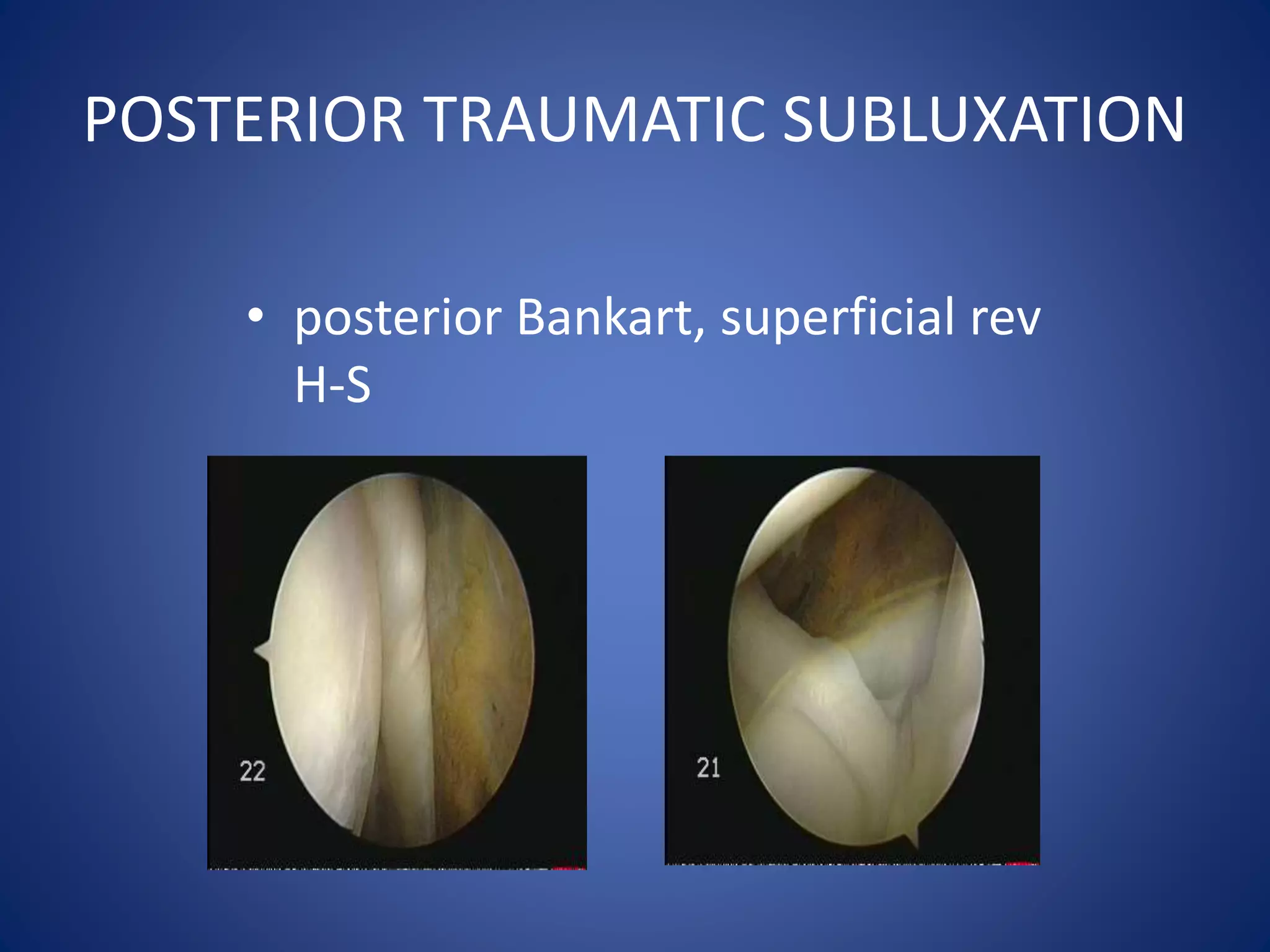 POSTERIOR TRAUMATIC SUBLUXATION 
• posterior Bankart, superficial rev 
H-S 
 