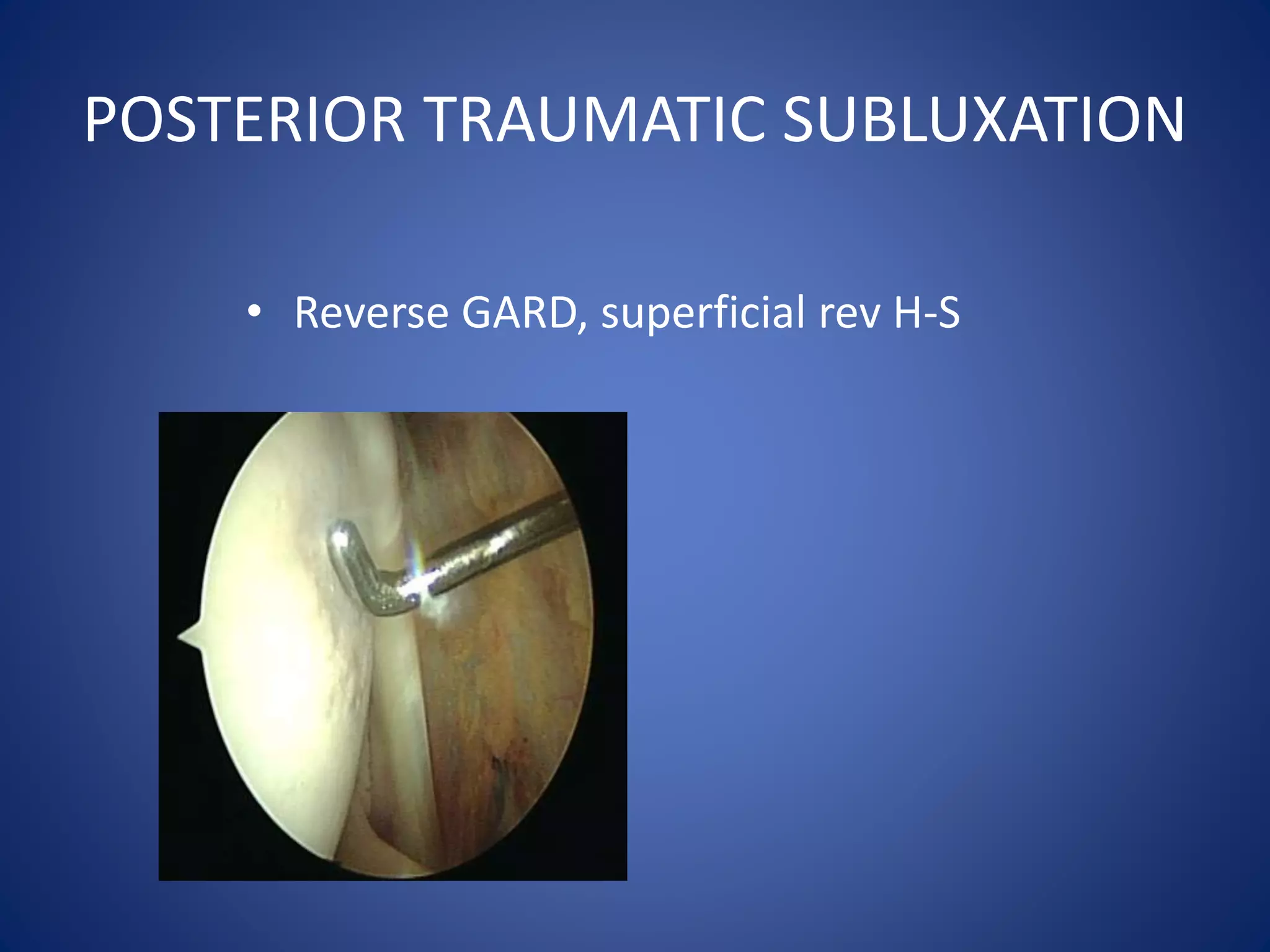 POSTERIOR TRAUMATIC SUBLUXATION 
• Reverse GARD, superficial rev H-S 
 