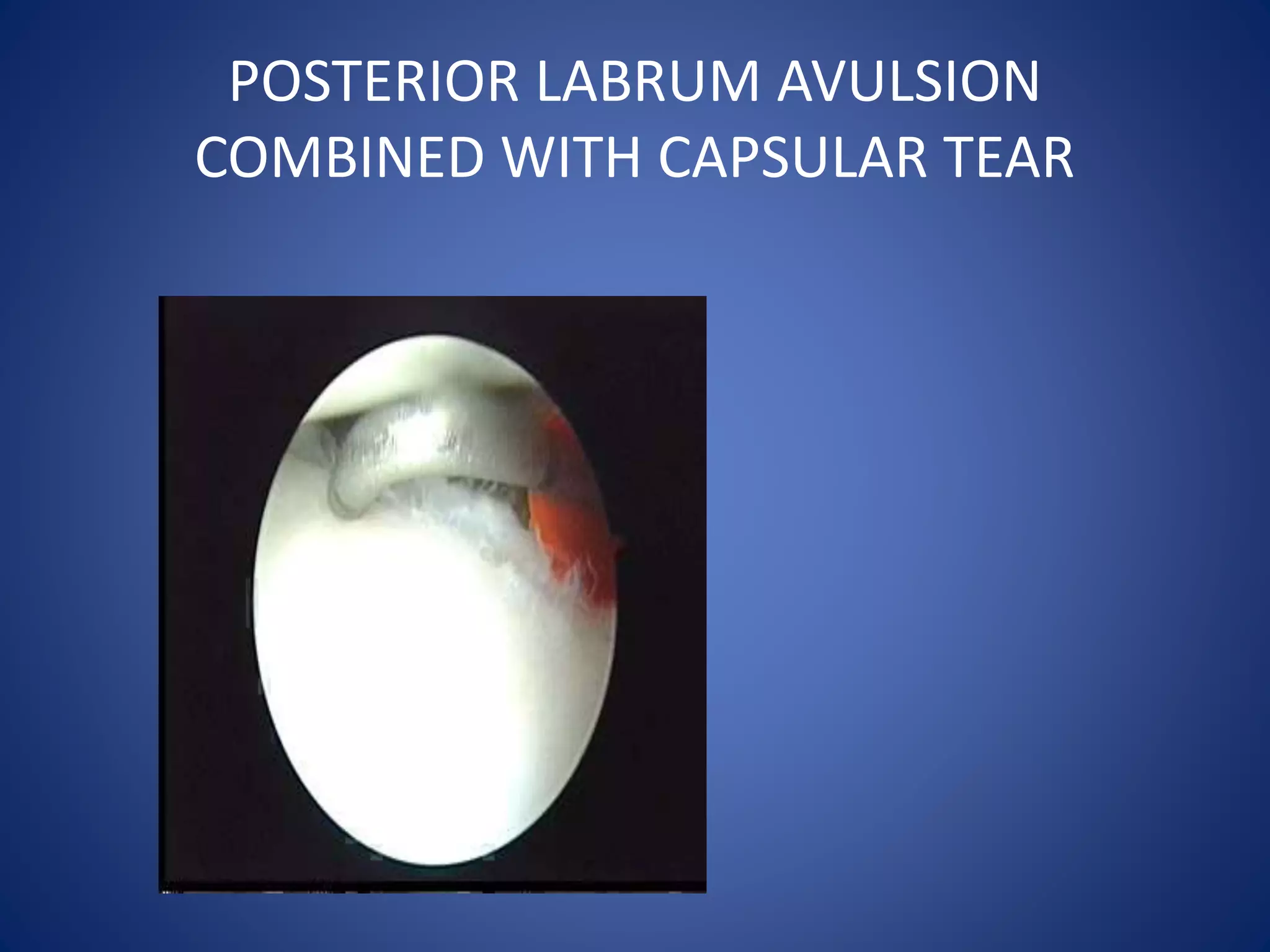 POSTERIOR LABRUM AVULSION 
COMBINED WITH CAPSULAR TEAR 
 