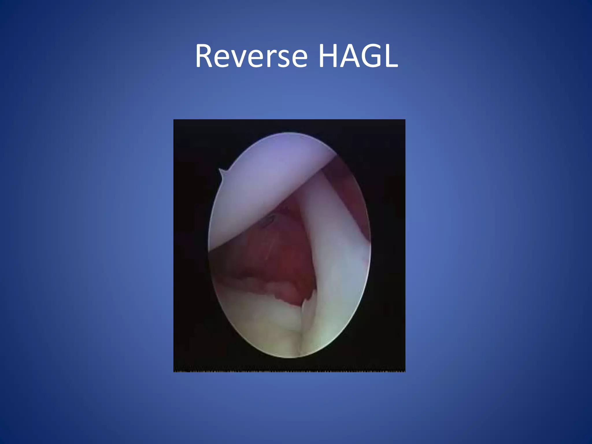 Reverse HAGL 
 