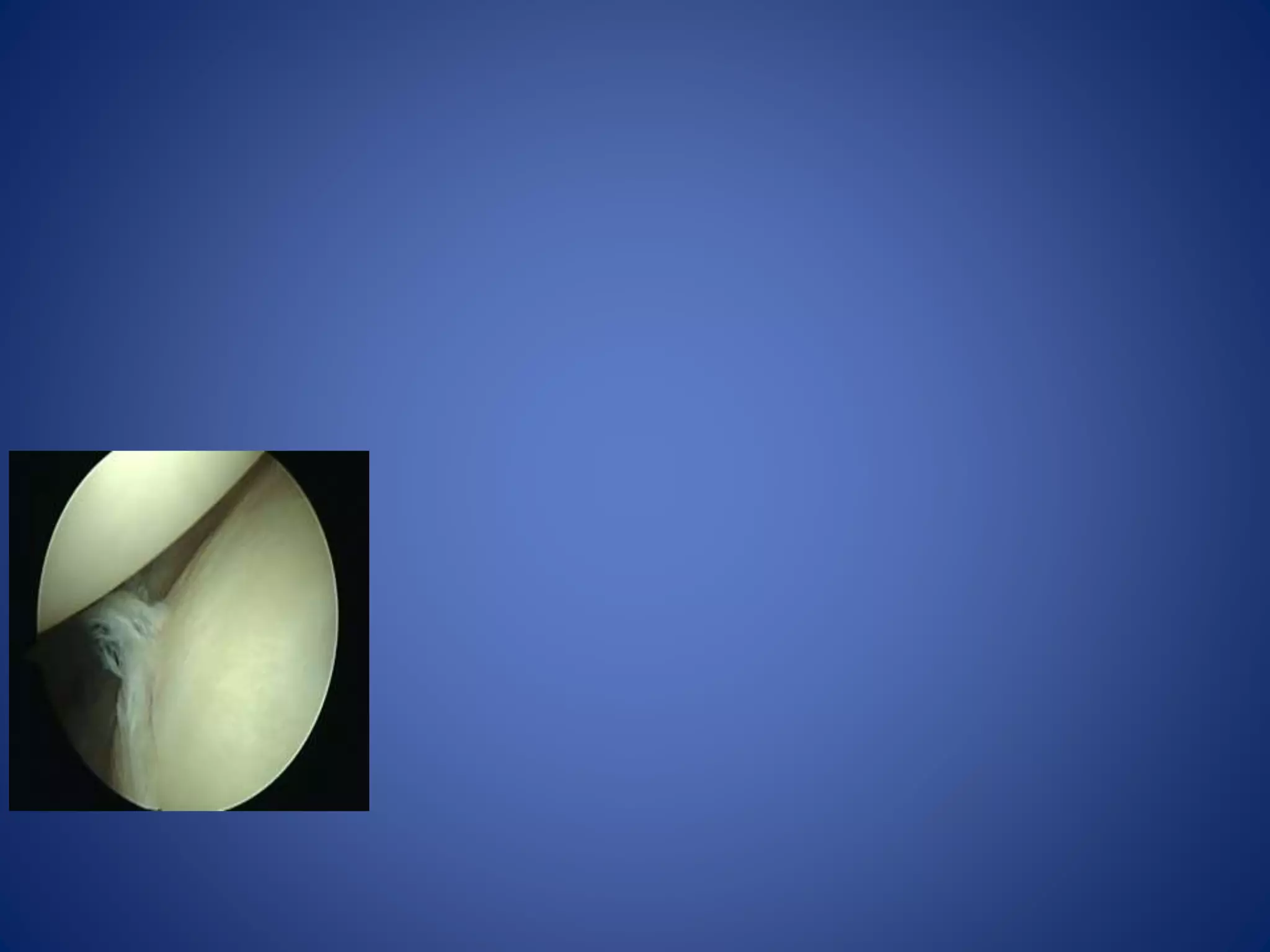 Post instability echte