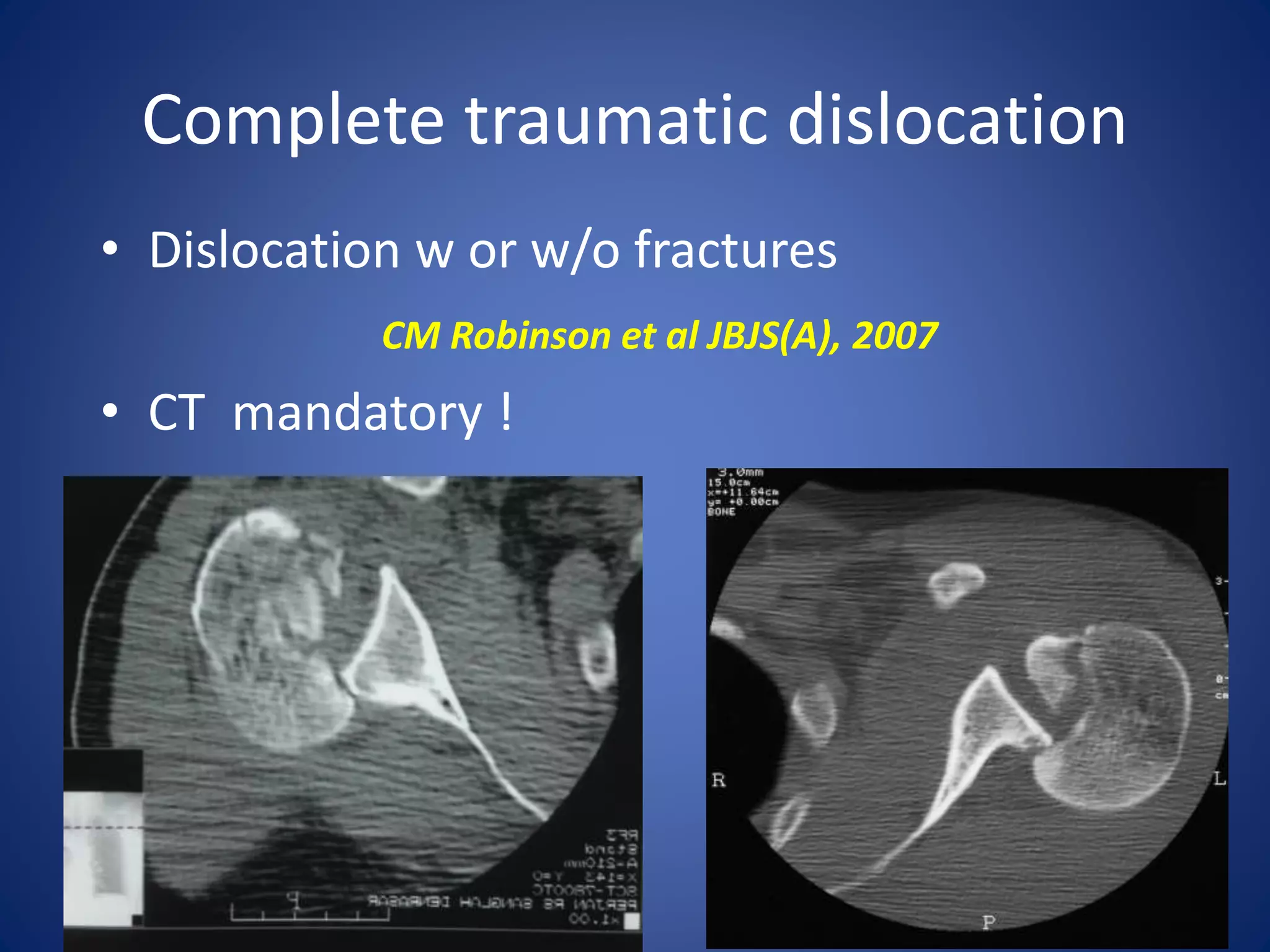 Complete traumatic dislocation 
• Dislocation w or w/o fractures 
CM Robinson et al JBJS(A), 2007 
• CT mandatory ! 
 