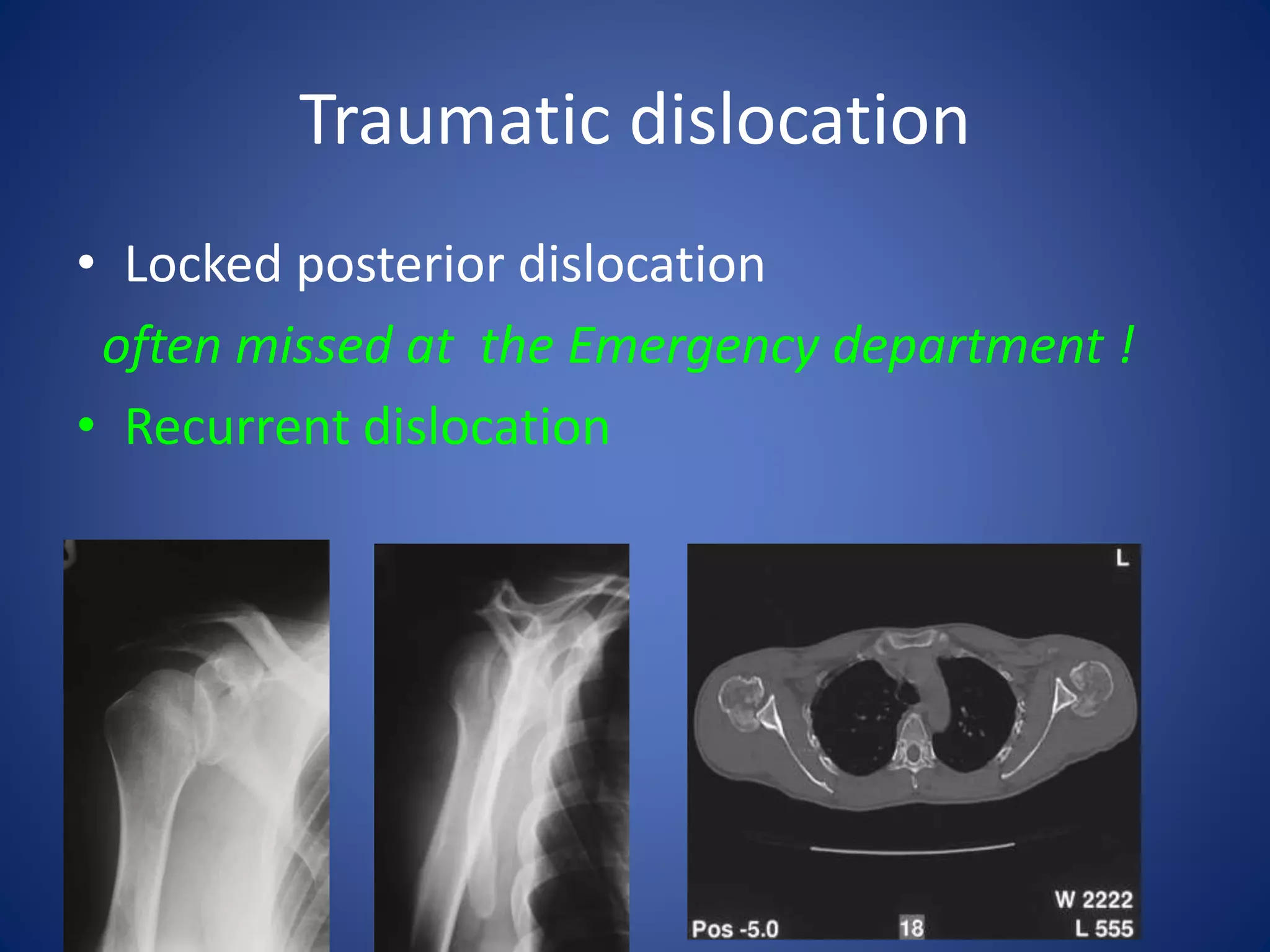 Traumatic dislocation 
• Locked posterior dislocation 
often missed at the Emergency department ! 
• Recurrent dislocation 
 