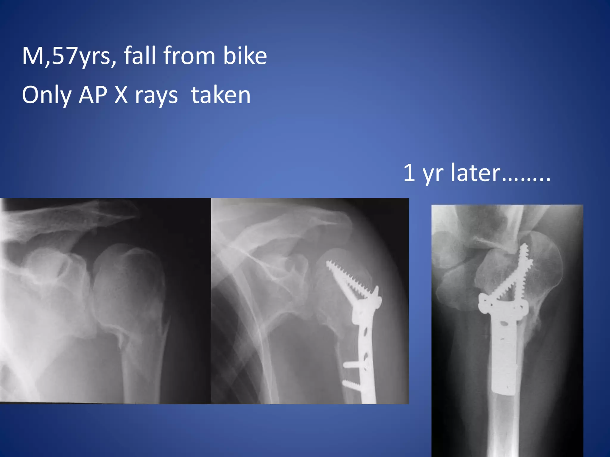 M,57yrs, fall from bike 
Only AP X rays taken 
1 yr later…….. 
 